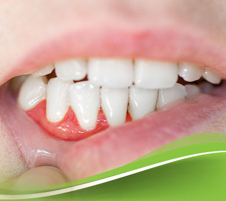 التهابات اللثة: أسبابها، أنواعها، وكيفية علاجها