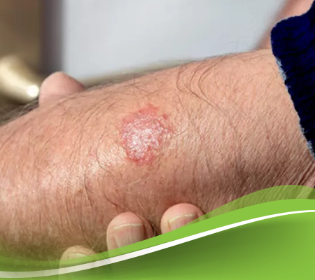 ما هي السعفة المبرقشة