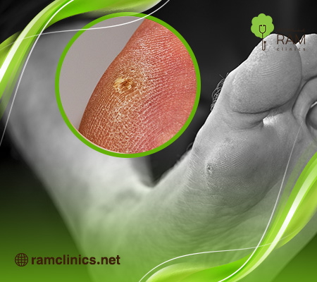 علاج مسمار القدم