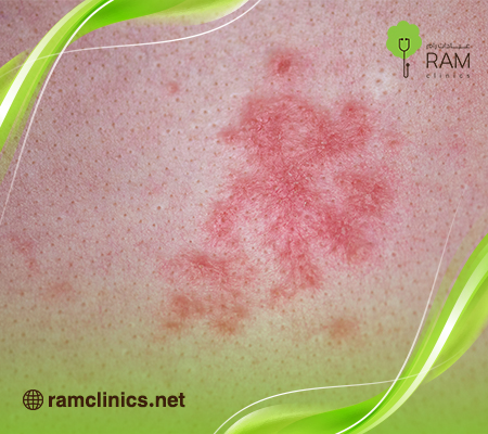 مرض-الزهري-للرجال