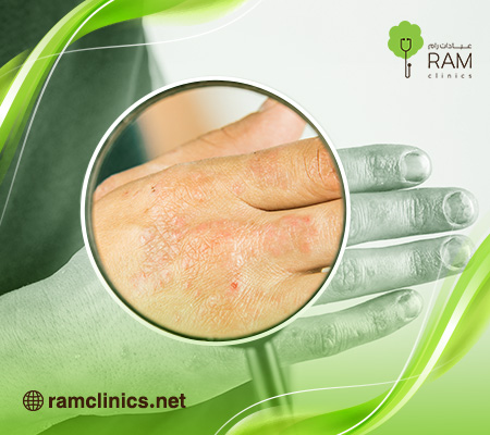 التهاب-الجلد-التأتبي