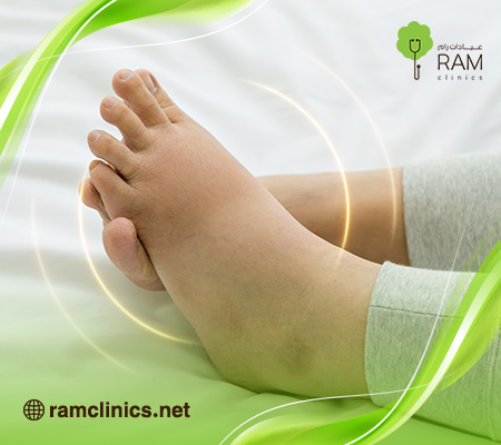 احتباس-السوائل-في-الجسم