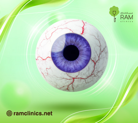 أعراض-العين-المتراكمة