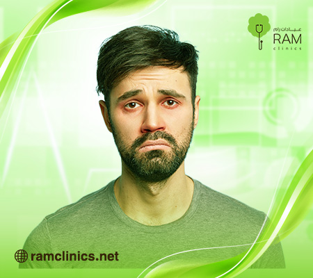 علاج-رمد-العين