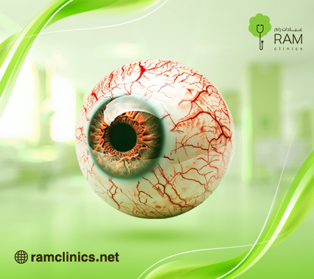 خدش-القرنية