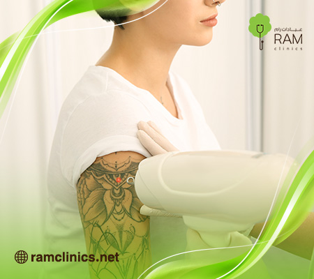 ازاله-التاتو