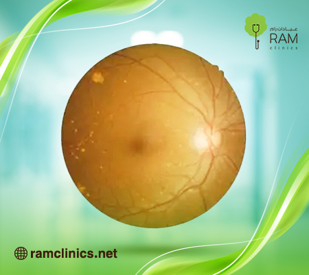 علاج-تلف-شبكية-العين