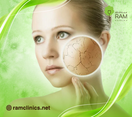 كيف اتخلص من تشققات الجسم