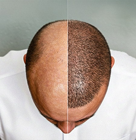 زراعة الشعر