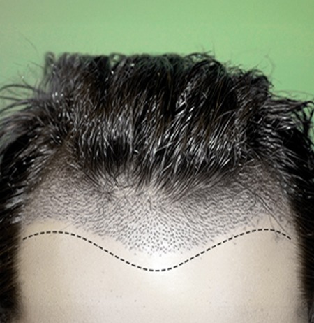 رسم خط مقدمة الرأس