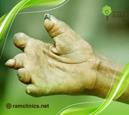 ما-هو-الجذام