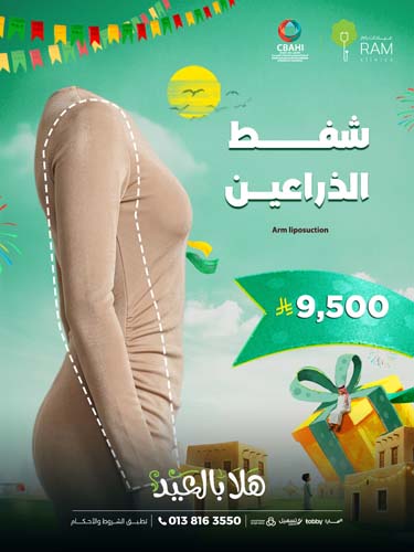 شفط الذراعين