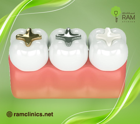 حشوة-الاسنان