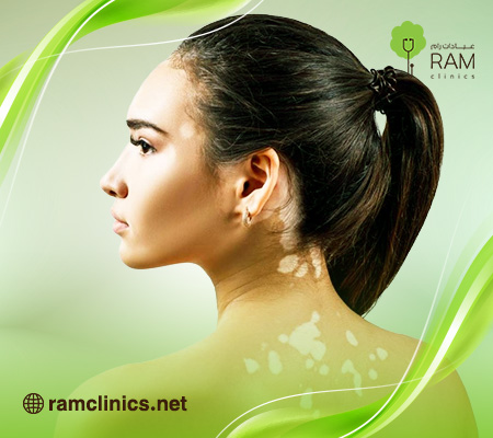 علاج-البهاق-بالليزر