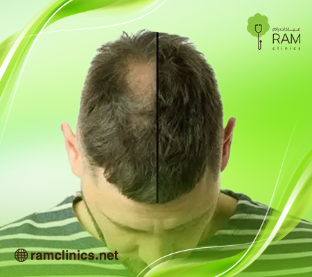 زراعة-الشعر-قبل-وبعد