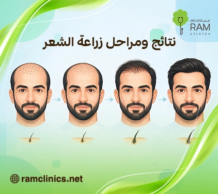 مراحل-نمو-الشعر-بعد-الزراعة