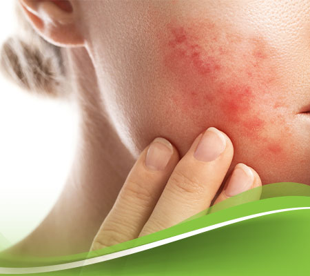 التهاب الجلد التحسسي بالصور