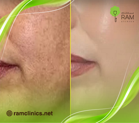 سكارليت للوجه قبل وبعد