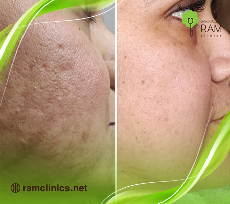 سكارليت قبل وبعد