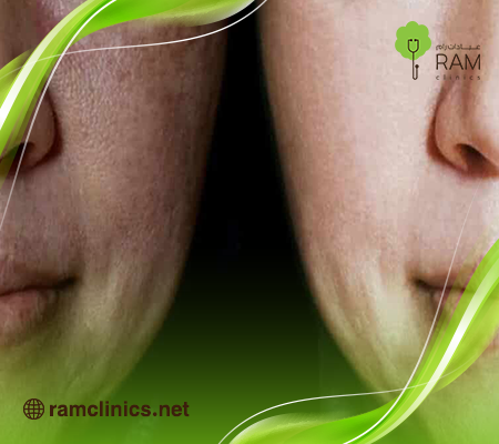 تجربتي مع جهاز سكارليت