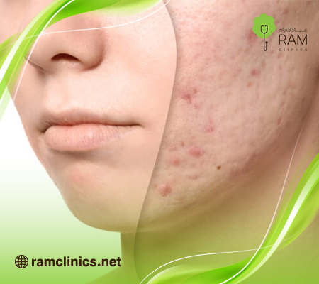 حبوب-الذقن-المؤلمة-تحت-الجلد
