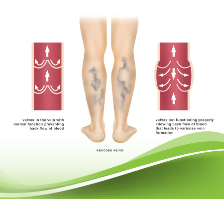  أماكن ظهور الدوالي عند النساء