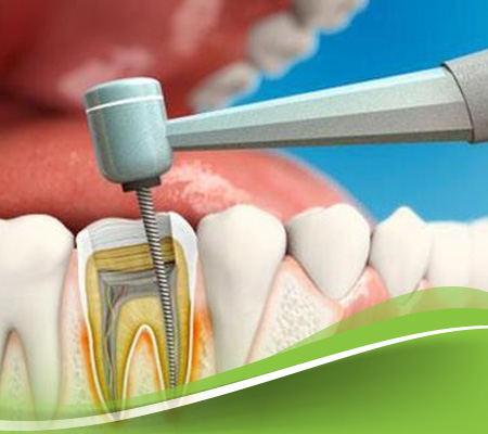 ماهو حشو العصب