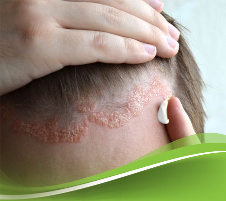 أنواع الأكزيما