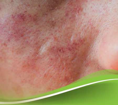 علاج الاكزيما نهائيا