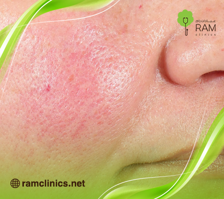 اسباب-جلسة-ريجين-لاب