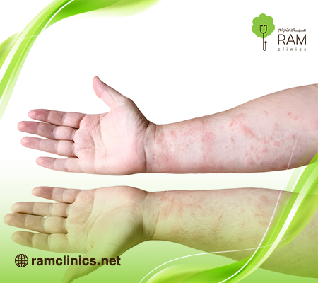 مرض-الزهري-للرجال