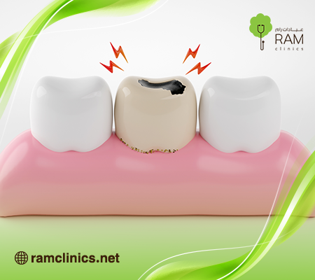 اعراض-تسوس-الاسنان