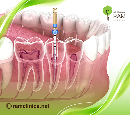 اعراض-تسوس-الاسنان