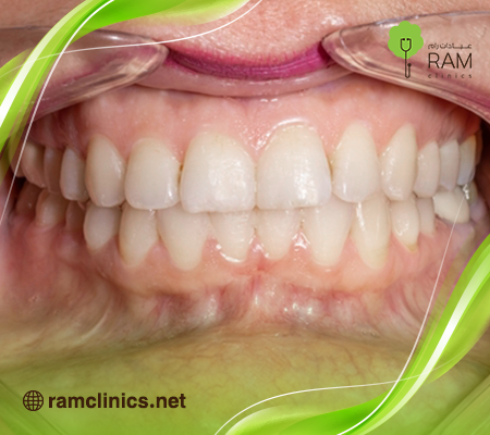 تطابق-الاسنان