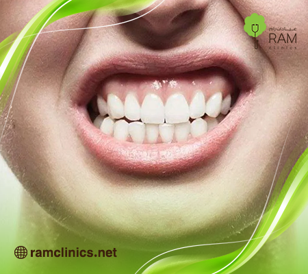 تطابق-الاسنان