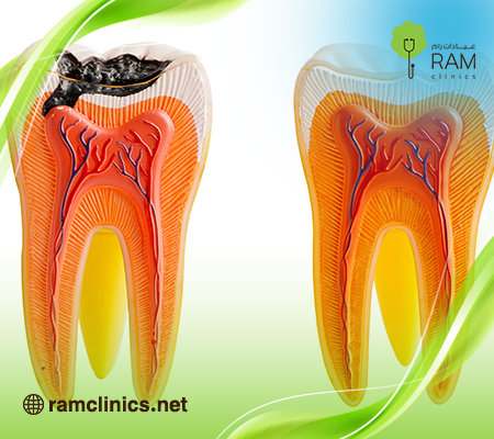 مراحل-التسوس