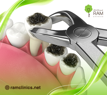 مراحل-التسوس