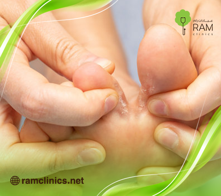 مرض-القدم-الرياضي مرض-القدم-الرياضي
