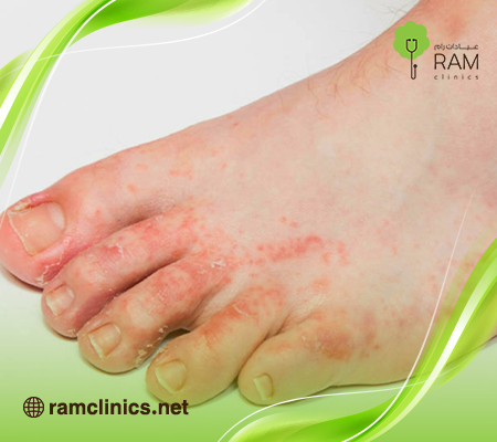 مرض-القدم-الرياضي مرض-القدم-الرياضي