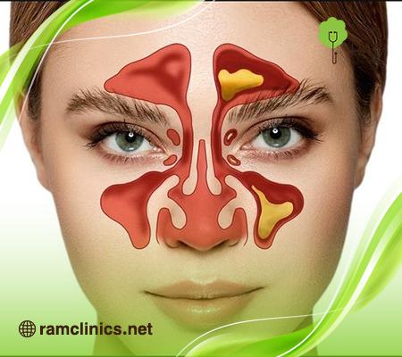 التهاب-الجيوب-الانفية التهاب-الجيوب-الانفية