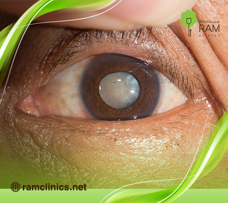 الماء-الأزرق-في-العين