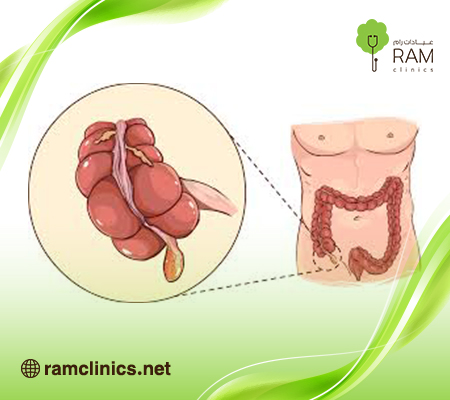 الزائدة-الدودية الزائدة-الدودية