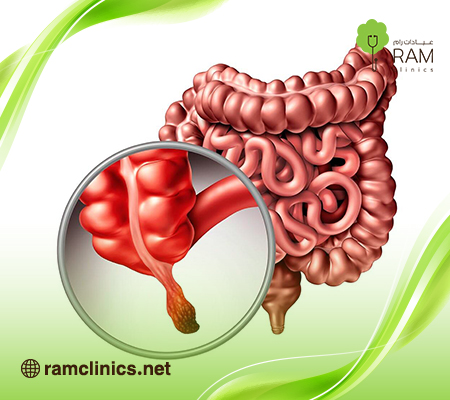 الزائدة-الدودية الزائدة-الدودية