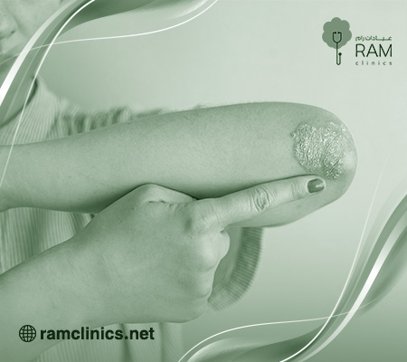 اعراض-التهاب-الجلد-التأتبي