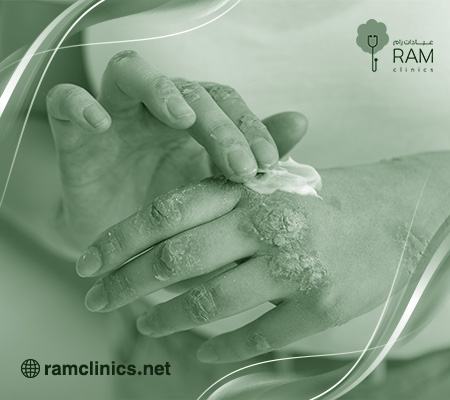 أسباب-التهاب-الجلد-التأتبي