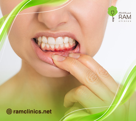 علاج-التهاب-اللثة-سريع-المفعول