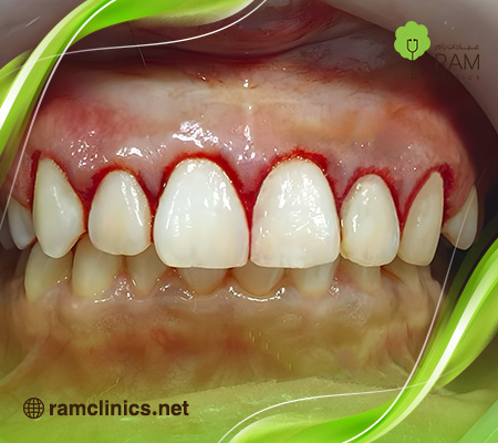 دواء-مسكن-ألم-عصب-الأسنان