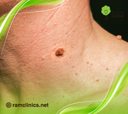 هذلول-الجلد