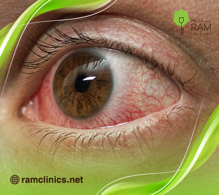 علاج-احمرار-العين