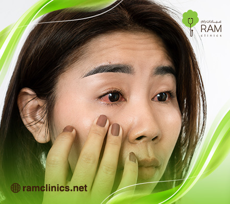 علاج-احمرار-العين-والحكة